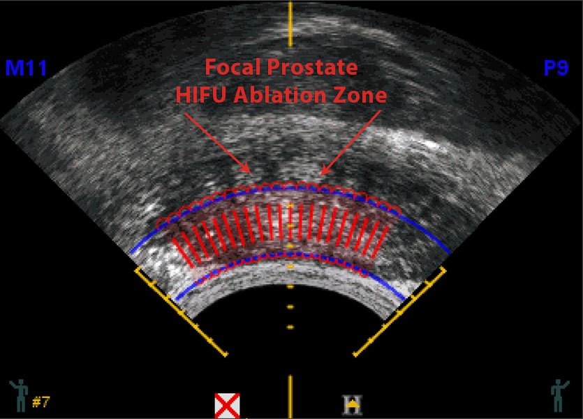 Ultrasound scan performed at time of HIFU for treatment of prostate cancer planning.