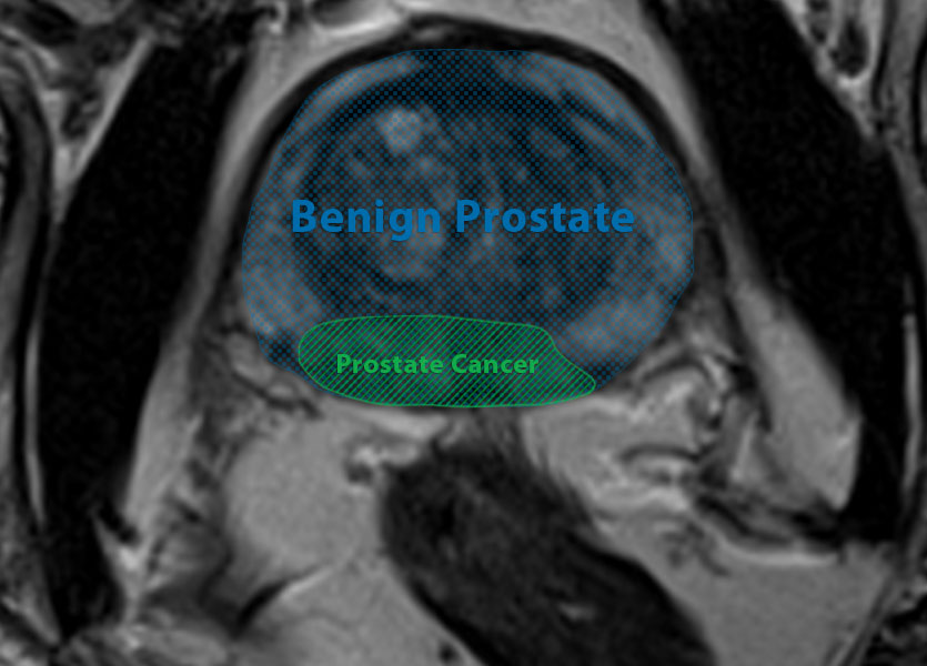 MRI scan of prostate cancer tumour.