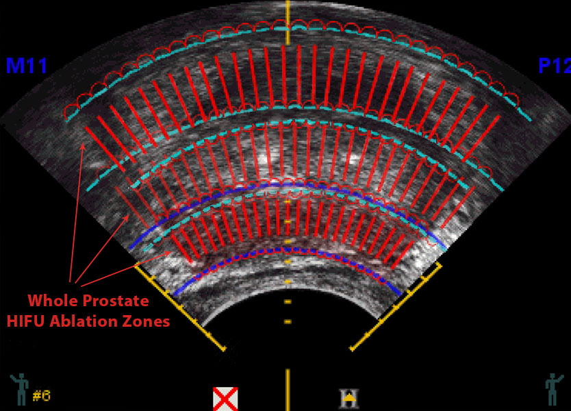Ultrasound scan performed at time of HIFU for treatment of prostate cancer planning.