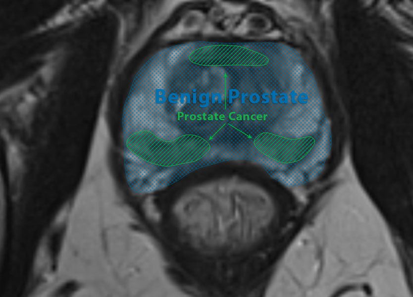MRI scan of prostate cancer tumour.